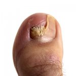 Онихомикоз. Грибковые поражения ногтей