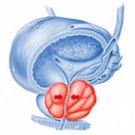 Народные методы лечения простатита и аденомы предстательной железы